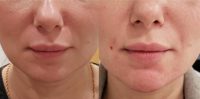 45-54 year old woman treated with Chin Fillers