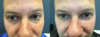 35-44 year old man treated with Injectable Fillers