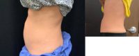 35-44 year old woman treated with Emsculpt
