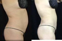 45-54 year old woman treated with BodyTite of the abdomen, also called a No-Cut Tummy Tuck