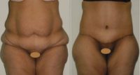 25-34 year old woman treated with Panniculectomy