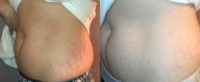 18-24 year old woman treated with Stretch Marks Treatment