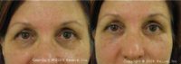 Treated with Restylane