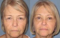 55-64 year old woman treated with Eye Bags Treatment and Upper Eyelid Surgery