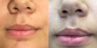 18-24 year old woman treated with Juvederm