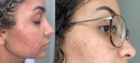 25-34 year old woman treated with Acne Treatment