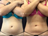 18-24 year old woman treated with SculpSure