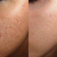 18-24 year old woman treated with Acne Scars Treatment