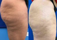 45-54 year old woman treated with Cellulite Treatment
