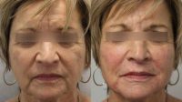 Patient treated with Voluma and Juvederm around cheeks and mouth