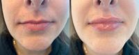 25-34 year old woman treated with Restylane Silk