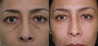 Facial Rejuvenation with Injectable Fillers