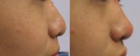 16 years old woman treated with Injectable Fillers