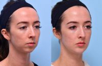 Bringing BALANCE to her Facial Features with a Lower Face Treatment