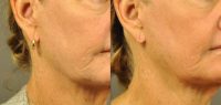 63 year old woman treated with Halo Laser