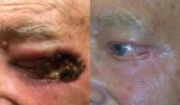 75 and up year old man treated with Mohs Surgery