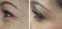 Botox for treatment of crows feet