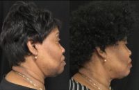 68 year old woman treated with Chemical Peel