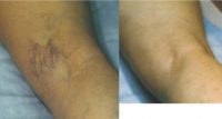 45-54 year old woman treated with Sclerotherapy