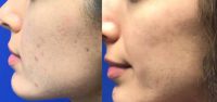 25-34 year old woman treated with Acne Scars Treatment