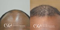 45-54 year old man treated for Hair Transplant