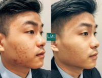 25-34 year old woman treated with Acne Scars Treatment