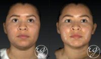 25-34 year old woman treated with Buccal Fat Removal and Vaser Liposuction