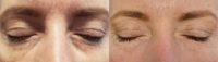 45-54 year old woman treated with Under Eye Filler for Dark Circles
