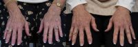 65-74 year old woman Pre and Post Radiesse Hand Treatment