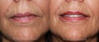 55-64 year old woman treated with Belotero & Restylane Silk