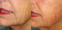 73 year old woman treated with InMode Fractora to jawline by mouth