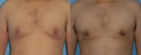 18-24 year old man treated with Male Breast Reduction