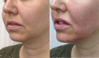 Woman treated with Juvederm