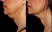 45-54 year old woman treated with Kybella, Dermal Fillers and RF for Skin Tightening.