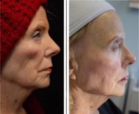 75 and up year old woman treated with Juvederm