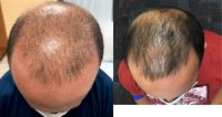PRP for the Treatment of Hair Loss