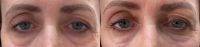 55-64 year old woman treated with Restylane Under her eyes with cannula