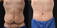 25-34 year old man treated with Body Lift
