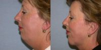 45-54 year old woman treated with Laser Liposuction of the neck