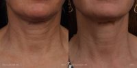 55-64 year old woman treated with Laser Resurfacing - Halo Pro and SkinTyte