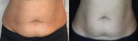 35-44 year old woman treated with Emsculpt