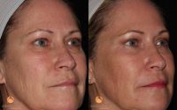 Female Patient Treated for Wrinkles and Texture with C02RE Fractional C02 Resurfacing Treatment