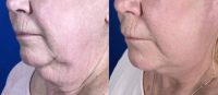 65-74 year old woman treated with Mini Facelift