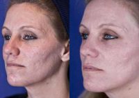 Fractional CO2 laser resurfacing for acne scarring