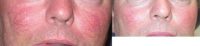 45-54 year old man treated with Yag Laser