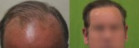 Norwood 3 Patient Achieves Natural Looking Hairline With 3500 Grafts