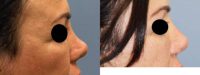 45-54 year old woman treated with Non Surgical Nose Job