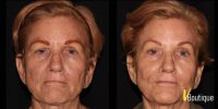 55-64 year old woman treated with Fractional Laser