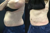 65-74 year old woman treated with CoolSculpting