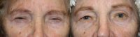 65-74 year old woman treated with Eyelid Repair